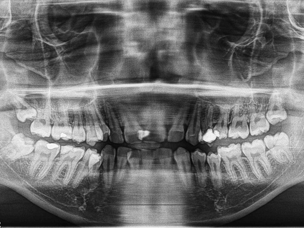 ENSOCARE PUNE Center OPG  Digital X Ray